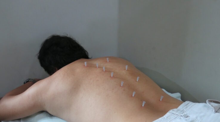 DN (Dry Needling)